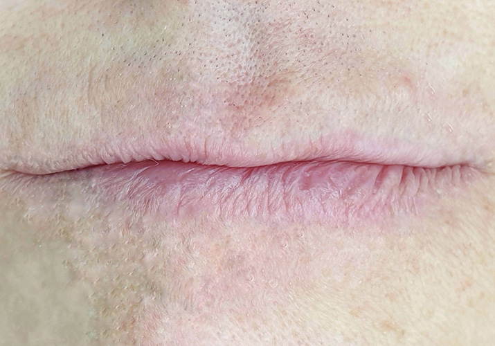 הסרת איפור קבוע שפתיים אחרי