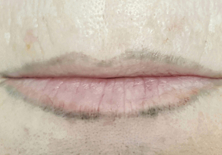 הסרת איפור קבוע שפתיים לפני